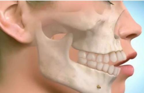 Răng hô là răng như thế nào? Biểu hiện và cách khắc phục tình trạng răng hô