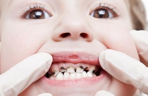 Áp-xe răng miệng ở trẻ em có nguy hiểm hay không?