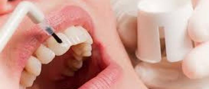 Vôi răng là gì? Nguyên nhân cần cạo vô răng và cách phòng tránh vôi răng
