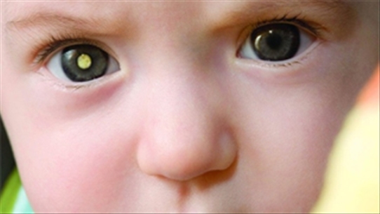 Những dấu hiệu giúp mẹ nhận biết bệnh ở mắt của trẻ em