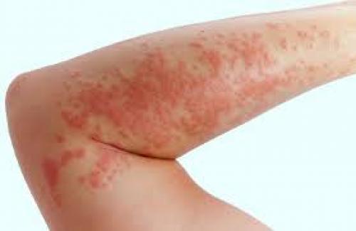 Eczema là bệnh gì? Triệu chứng, nguyên nhân và phương pháp điều trị bệnh