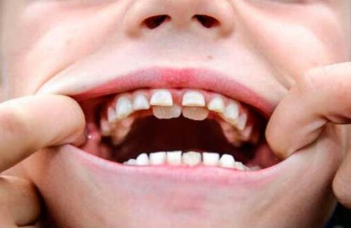 Tiềm ẩn những nguy hại khi nhổ răng sữa sớm cho trẻ em
