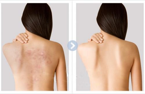 Mụn dưới da ở lưng: Nguyên nhân và cách điều trị bệnh