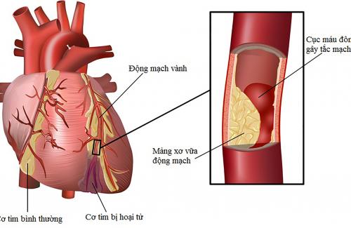 Các yếu tố nguy cơ thường gặp nhất của bệnh tim mạch