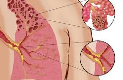 Xơ hóa phổi là bệnh gì? Nguyên nhân và phương pháp điều trị bệnh
