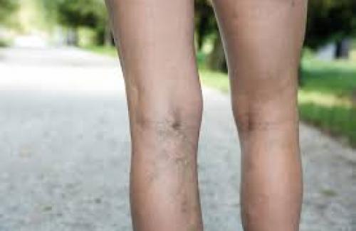 Phù chân là bệnh gì? Biểu hiện và những cảnh báo khi bị phù chân