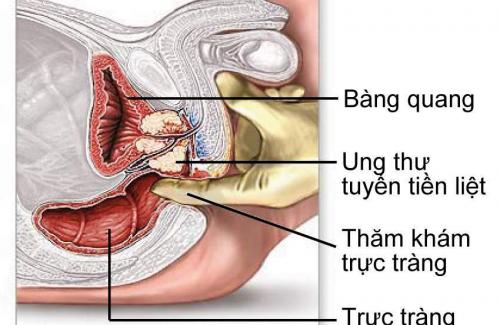 Tế bào tiền ung thư là gì? Mức độ, triệu chứng và phương pháp điều trị