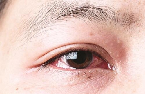 Biện pháp bảo vệ đôi mắt của bạn khỏi dịch đau mắt đỏ