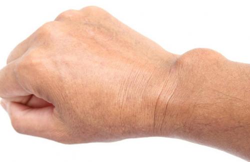 Triệu chứng tê bại ở tay có thể xuất phát từ 10 nguyên nhân không ngờ