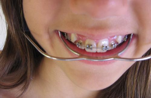 Chỉnh hình răng là gì? Thời điểm và cách chăm sóc răng miệng sau chỉnh nha