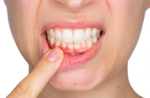 Trám răng là gì? Những trường hợp cần trám răng thẩm mỹ