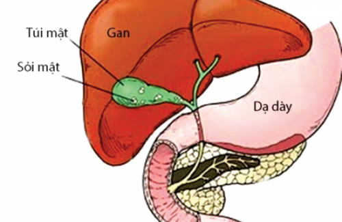 Tắc nghẽn đường mật là bệnh gì? Biểu hiện, nguyên nhân và cách phòng tránh