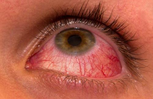 Đau mắt đỏ là sao- Triệu chứng, nguyên nhân, cách phòng và điều trị bệnh