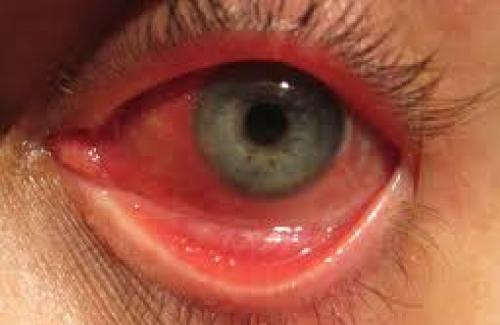 Đau mắt hột là gì? Triệu chứng, nguyên nhân và cách điều trị bệnh