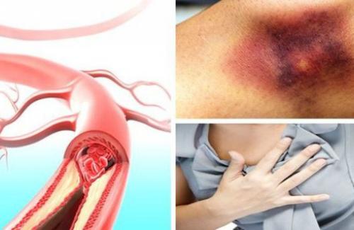 Bật mí 8 đối tượng nguy cơ cao mắc huyết khối tĩnh mạch