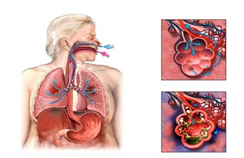 Hội chứng suy hô hấp cấp ARDS: Kẻ giết người thầm lặng