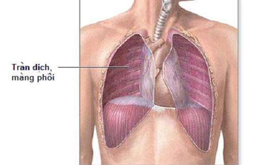 Tràn dịch màng phổi là gì? Triệu chứng và các nguyên nhân gây bệnh
