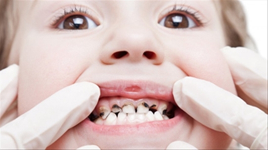Thuốc nam đơn giản, dễ tìm chữa đau răng nhiều người chưa biết