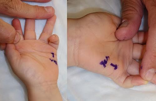 Phát hiện sớm và xử lý tật ngón tay bật ở trẻ như thế nào?
