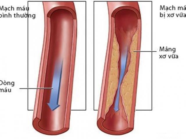 5 biến chứng cực kỳ nguy hiểm của bệnh rối loạn lipid máu