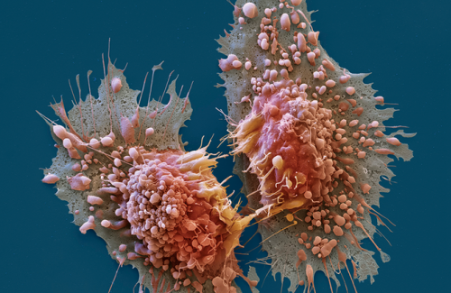 10 thứ mà tế bào ung thư yêu thích nhất, bạn đang nuôi dưỡng chúng hằng ngày!