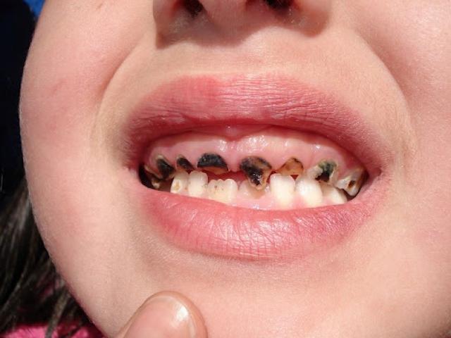 Sâu răng ở trẻ em có thể gây nhiều hậu quả đáng tiếc