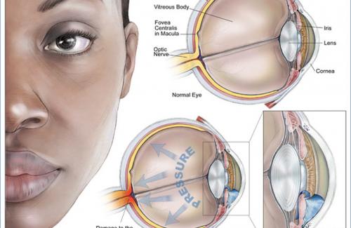Bệnh glaucoma là bệnh gì? Biểu hiện và những nguy cơ mắc bệnh