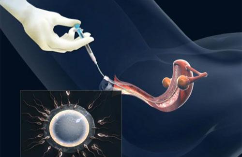 Trường hợp nào nên áp dụng bơm tinh trùng để thụ thai?