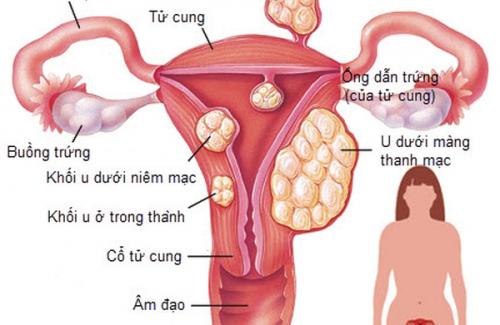 Nang naboth cổ tử cung là bệnh gì? Triệu chứng, nguyên nhân và điều trị bệnh