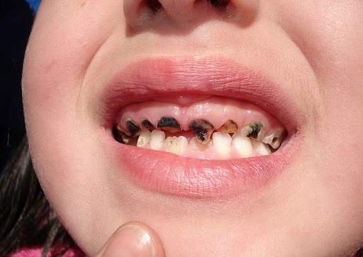 Ðừng để sâu răng gây hậu quả vô cùng đáng tiếc cho trẻ em