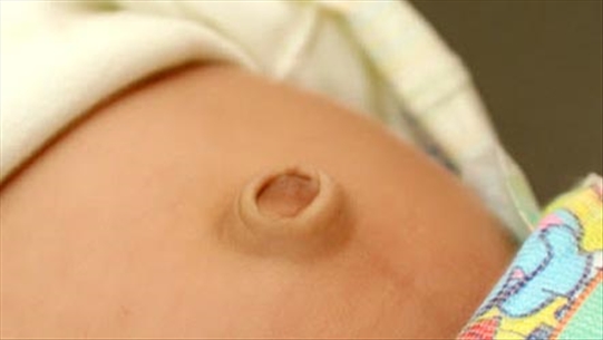 Thoát vị rốn ở trẻ sơ sinh - một dị tật khá phổ biến ở trẻ sơ sinh