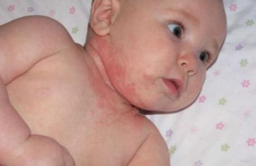 Cách điều trị trẻ sơ sinh bị viêm da tại nhà giúp bé khỏi bệnh nhanh