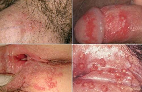 Herpes sinh dục là gì? Triệu chứng và cách nhận biết bệnh