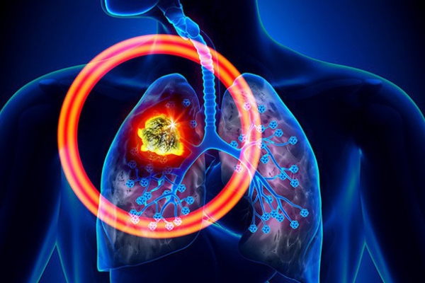 Những triệu chứng mà hầu hết dân văn phòng đều mắc nhưng cũng có thể là dấu hiệu ung thư phổi