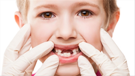 Nên làm gì khi trẻ bị sún răng để không ảnh hưởng gì tới răng vĩnh viễn?