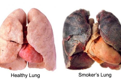 Nhận biết ung thư phổi giai đoạn đầu và khi bệnh phát triển nặng qua hơi thở bạn