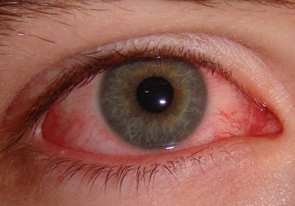 Bệnh đau mắt đỏ: Nguyên nhân, phòng và trị bệnh đau mắt hiệu quả
