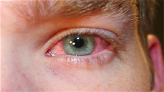 Một số lưu ý khi dùng thuốc kháng sinh chữa đau mắt đỏ