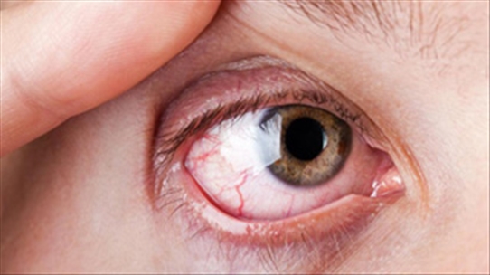 Đau mắt hột gây ra biến chứng lông quặm nên dùng thuốc gì?