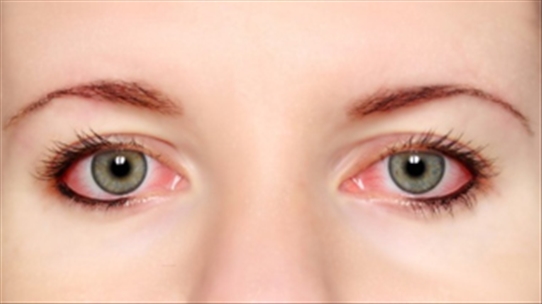 Tự chữa bệnh đau mắt đỏ: Có thể dẫn tới biến chứng cực nguy hiểm!