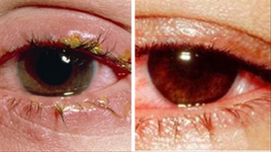 Đau mắt đỏ có thể dễ nhầm với viêm nội nhãn dẫn đến mù lòa