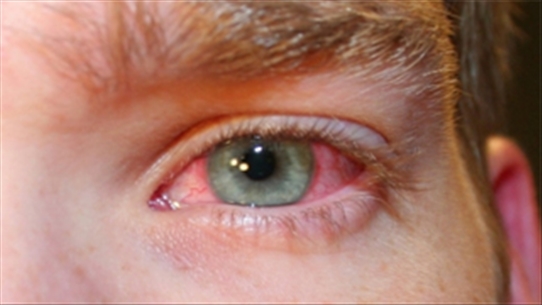 Hóa ra đây là con đường lây nhiễm chính của bệnh đau mắt đỏ
