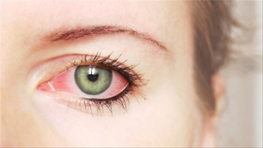 Những điều nên và không nên khi điều trị bệnh đau mắt đỏ?