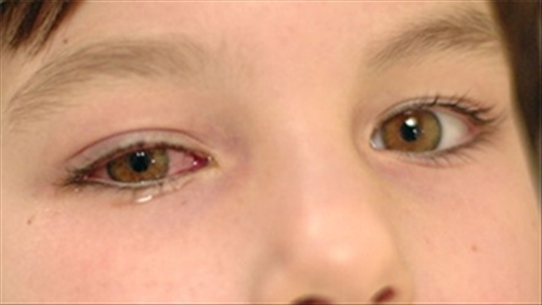 Một số cách để phân biệt đau mắt đỏ với thiên đầu thống