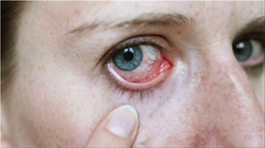 Mẹo chữa trị đau mắt đỏ hiệu quả bằng những biện pháp tự nhiên