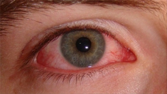 Mẹo chữa đau mắt đỏ ngay tại nhà để nhanh chóng thoát khỏi cảm giác khó chịu
