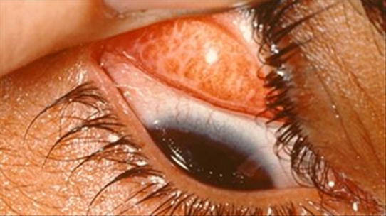 Triệu chứng, biểu hiện và biến chứng của bệnh đau mắt hột
