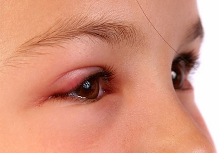 Những điều nên biết về bệnh đau mắt đỏ để có phương án phòng tránh