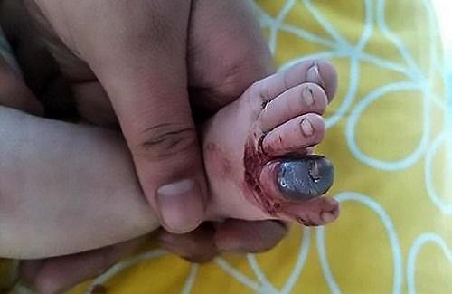Ngón chân bé 2 tháng HOẠI TỬ bầm đen phải cắt bỏ chỉ vì 1 SỢI TÓC của mẹ rơi trên giường