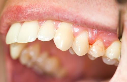 Nướu răng là gì? Những bệnh lý liên quan đến nướu răng